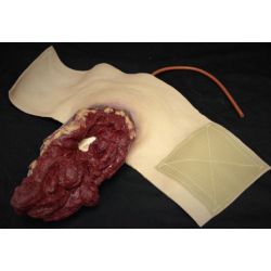 amputation du bras