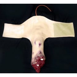 amputation d'une jambe