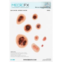 Fiche sur les mélanomes