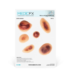 Contusions et ecchymoses