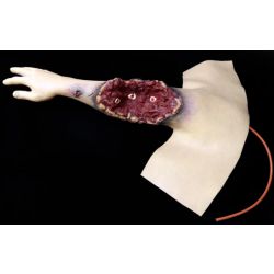 Amputation partielle du bras (droit)