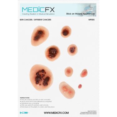 Fiche sur les mélanomes